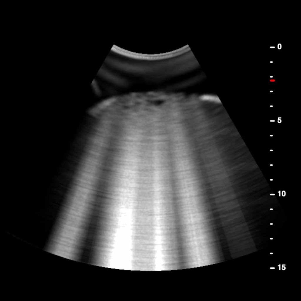 How To Successfully Perform A Lung Ultrasound Scan Using The POCUS ...